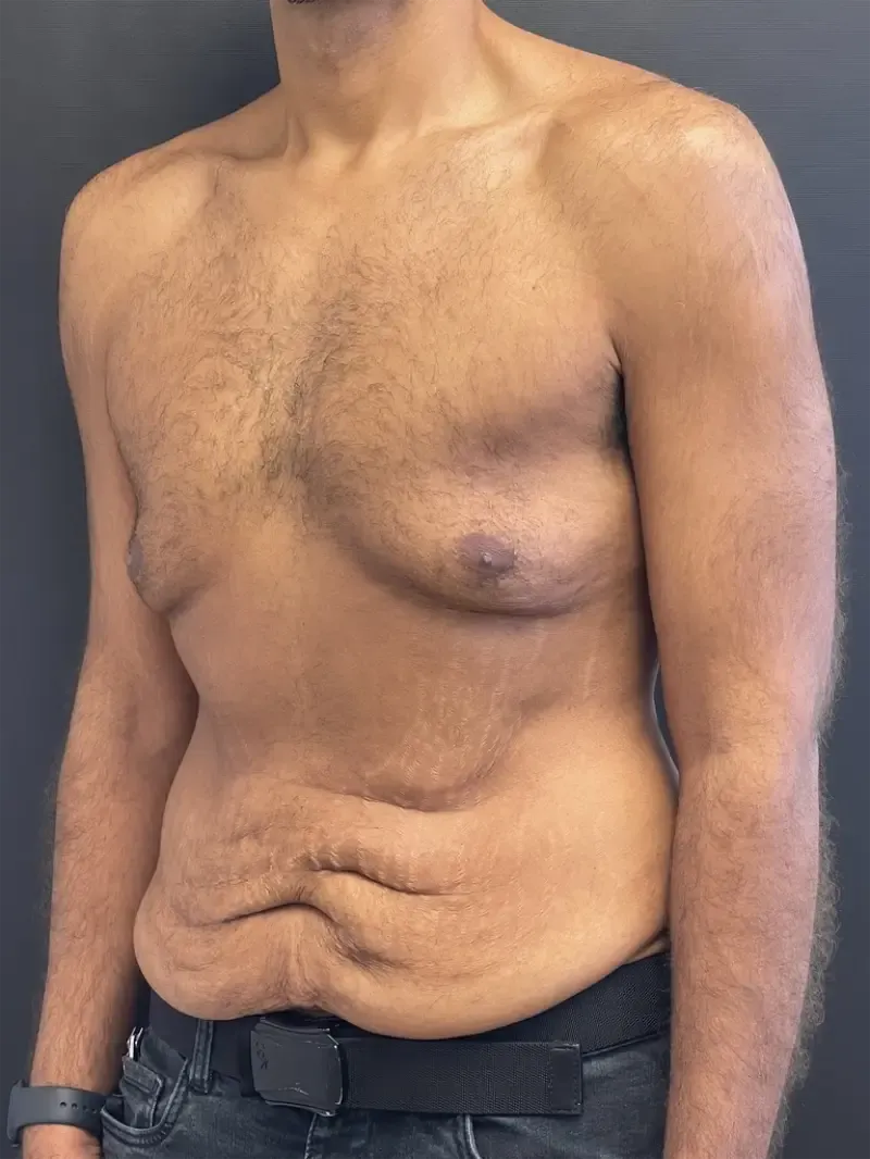 Surgery After Weight Loss before — Surgery After Weight Loss, view 2