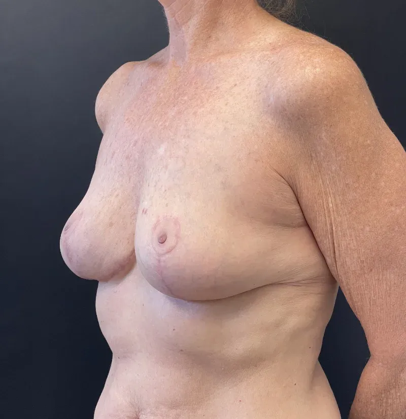 Breast Implant Removal after — Breast Implant Removal and Breast Lift, view 2