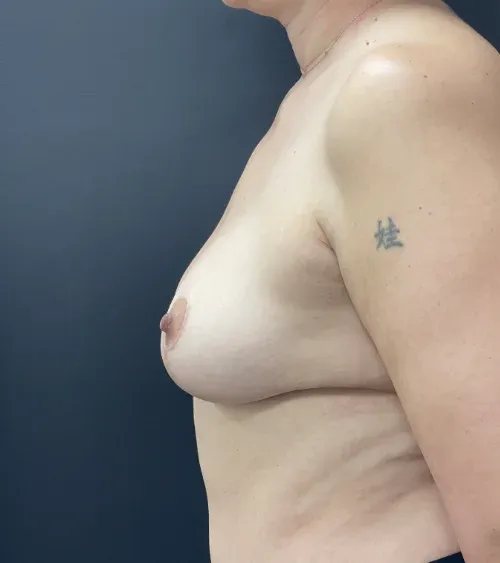 Breast Lift after — Breast Lift, view 3