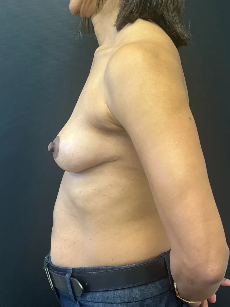 Breast Implant Removal after — Breast Implant Removal and Breast Lift, view 3
