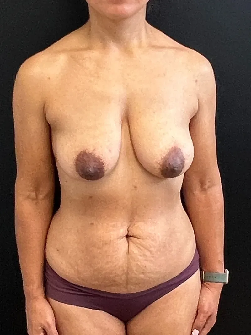 Mommy Makeover patient 1, before surgery
