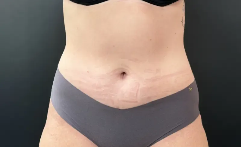 Tummy Tuck and Liposuction after — Tummy Tuck