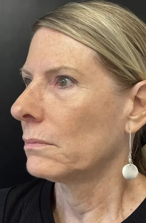 Facelift before — Face & Neck Lift and Phenol Peel around the eyes, nose and mouth