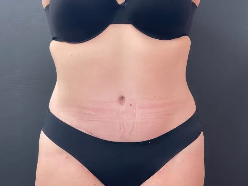 Tummy tuck and liposuction patient 2, after surgery