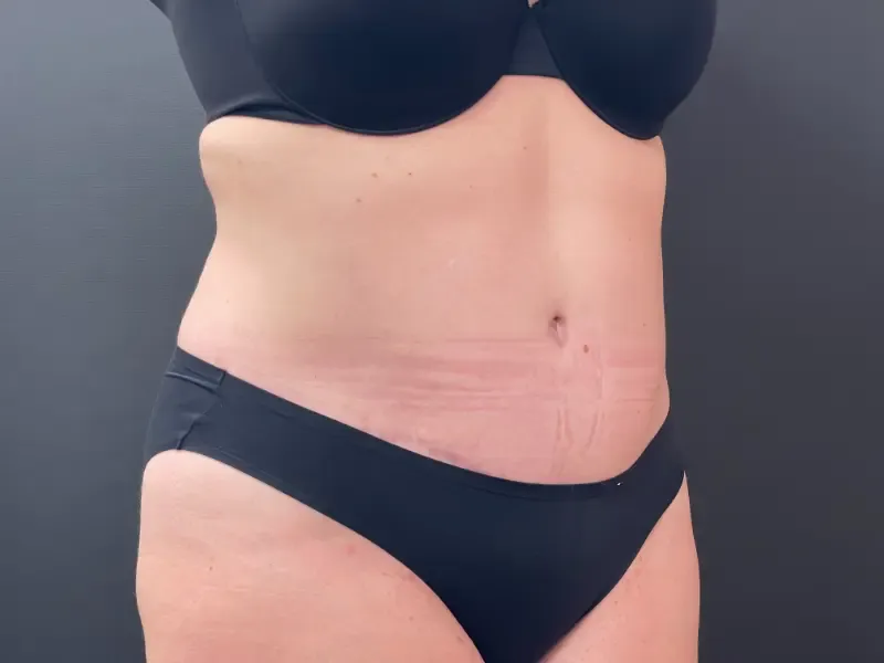 Tummy Tuck and Liposuction after — Liposuction and Tummy Tuck, 6 Months After, view 2