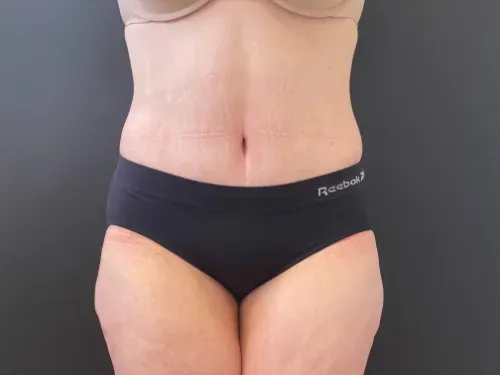 Tummy tuck patient 3, after surgery