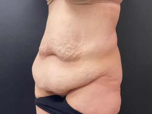 Tummy Tuck and Liposuction before — Tummy Tuck, view 2