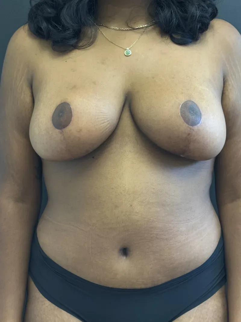 Mommy Makeover patient 2, after surgery