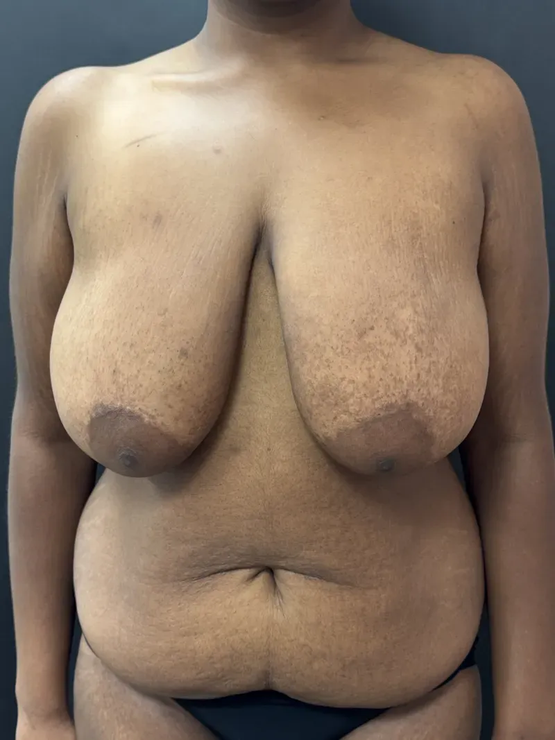 Mommy Makeover patient 2, before surgery