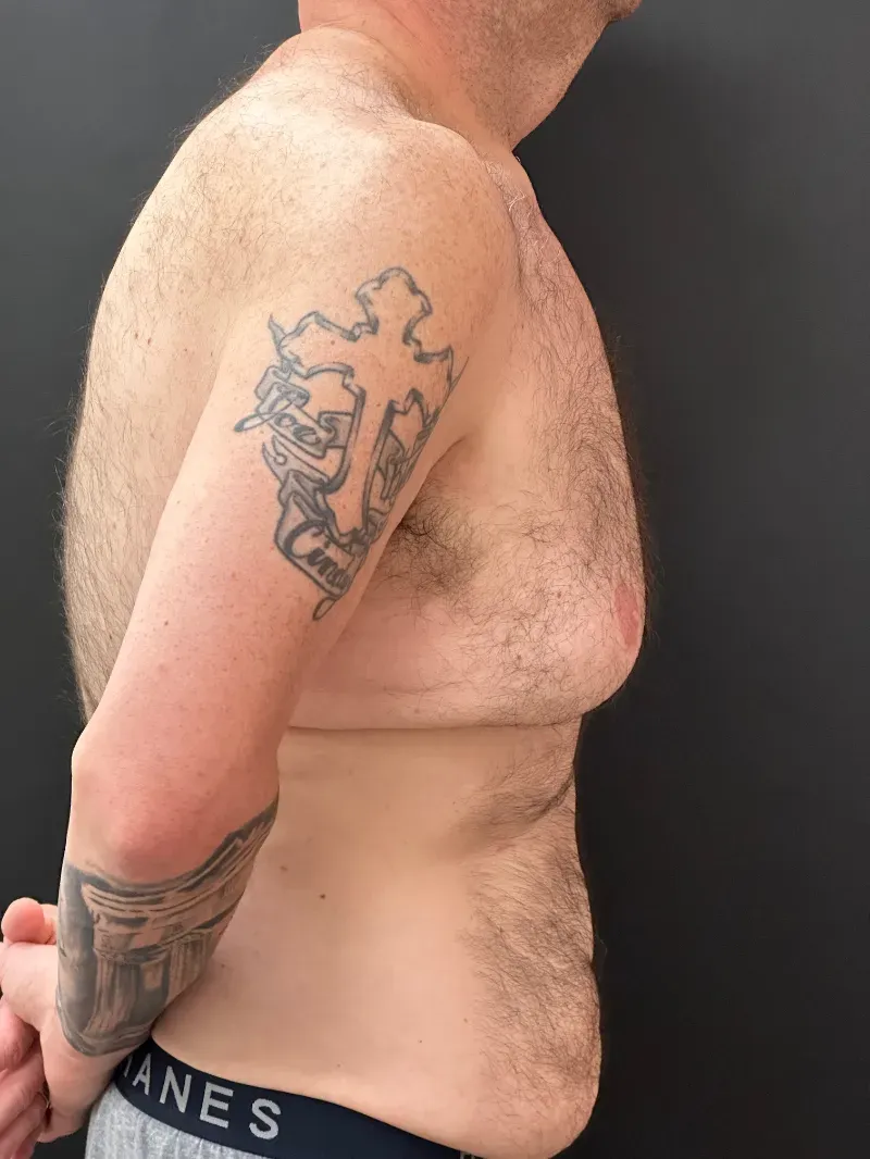 Gynecomastia before — Gynecomastia, view 3