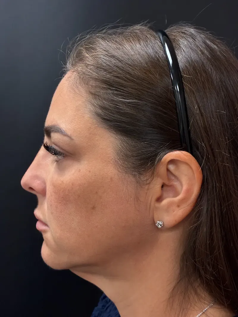 Facelift before — Face and Neck Lift, view 3