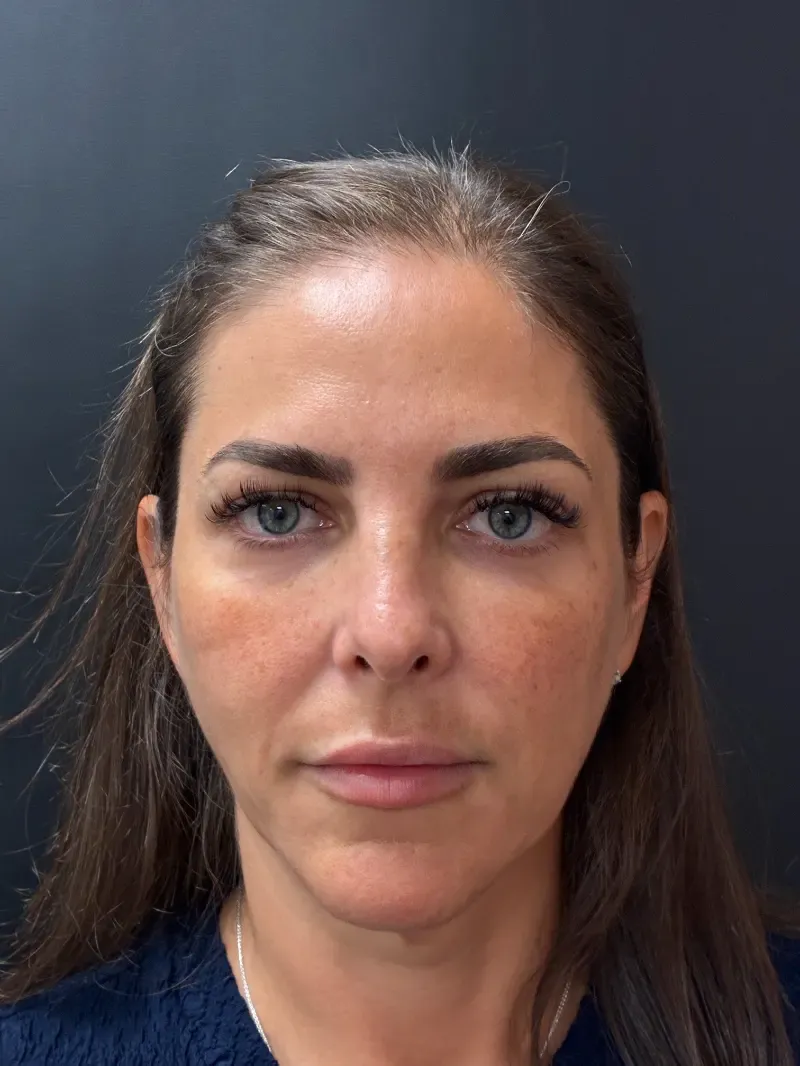 Facelift before — Face and Neck Lift, view 1
