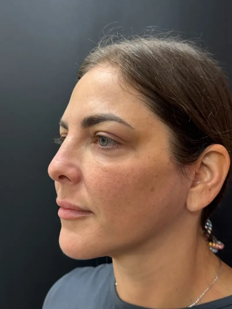 Facelift after — Face and Neck Lift, view 2