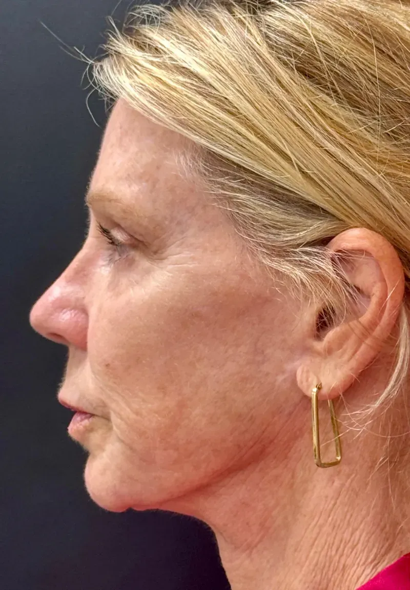 Laser Skin Resurfacing before — Deep Sciton Erbium Laser Resurfacing