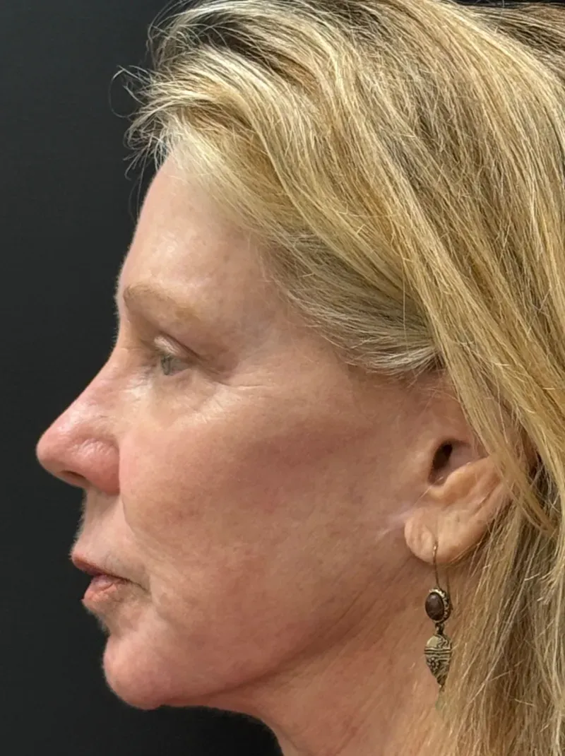 Laser Skin Resurfacing after — Deep Sciton Erbium Laser Resurfacing