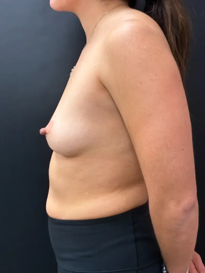 Breast augmentation before, MOTIVA DEMI 340cc, 360cc Breast Augmentation, view 3