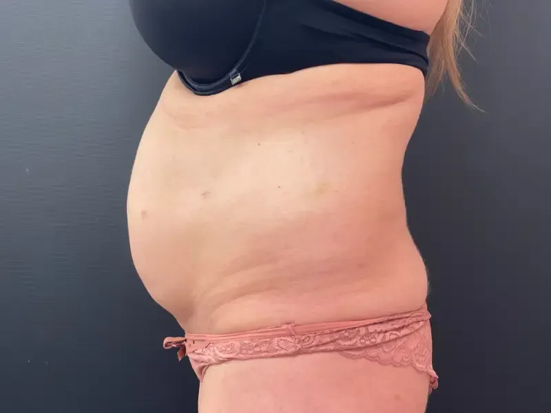 Tummy Tuck and Liposuction before — Tummy Tuck, view 3