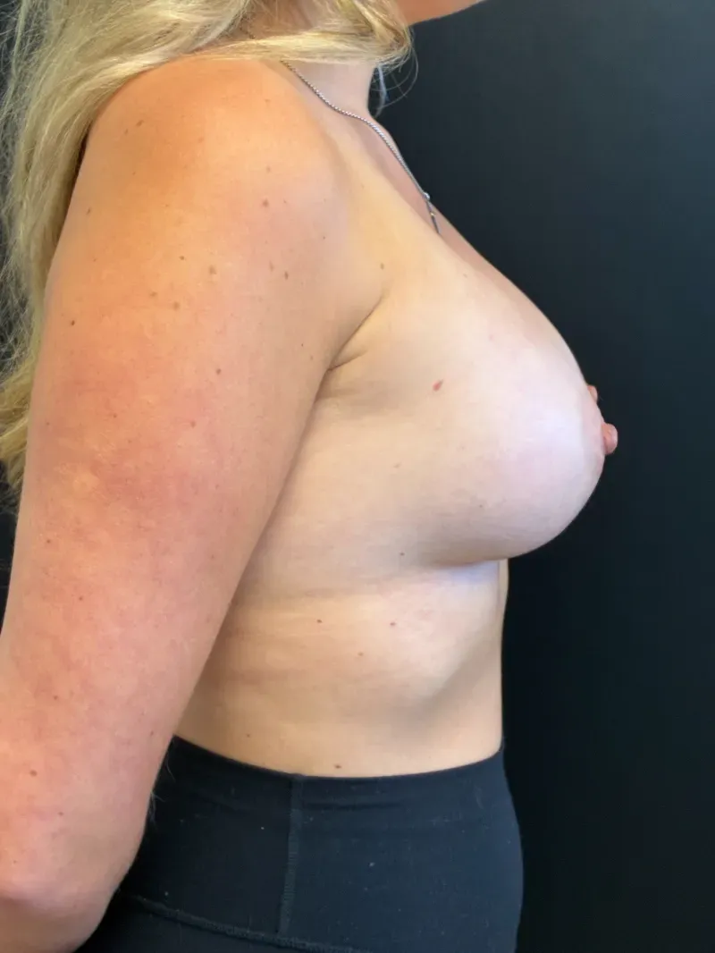 Breast augmentation after, Motiva Demi Ergonomix 340cc, view 3