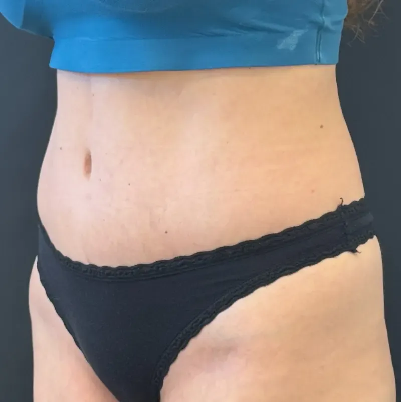 Tummy Tuck and Liposuction after — Tummy Tuck, view 2