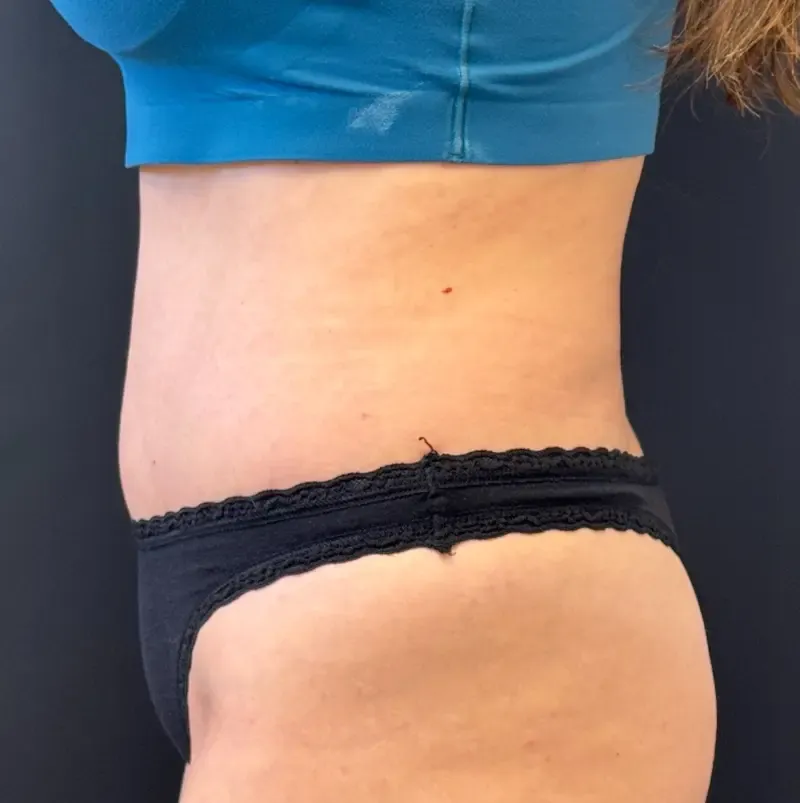 Tummy Tuck and Liposuction after — Tummy Tuck, view 3