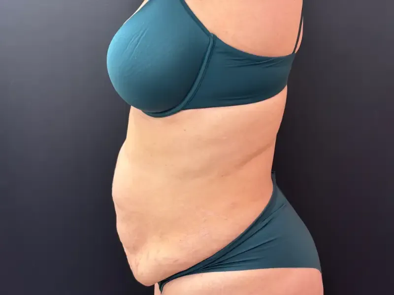 Tummy Tuck and Liposuction before — Tummy Tuck & Liposuction, view 3