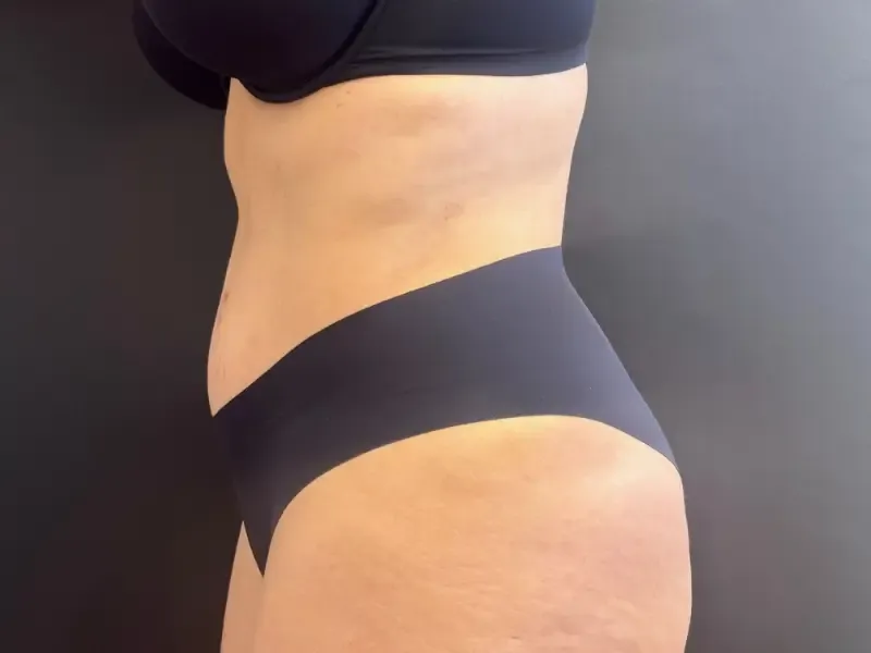 Tummy Tuck and Liposuction after — Tummy Tuck & Liposuction, view 3