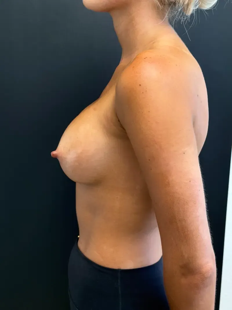 Breast augmentation after, 230cc Demi Motiva Ergonomix, view 3