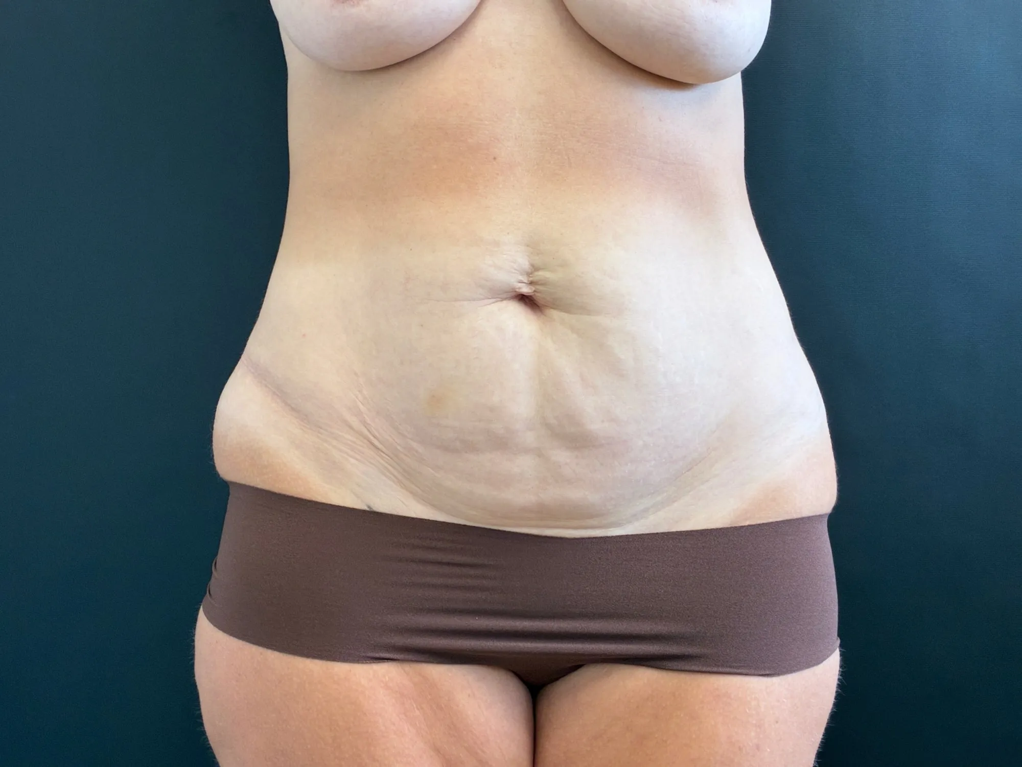 Tummy Tuck and Liposuction before — Tummy Tuck, view 1
