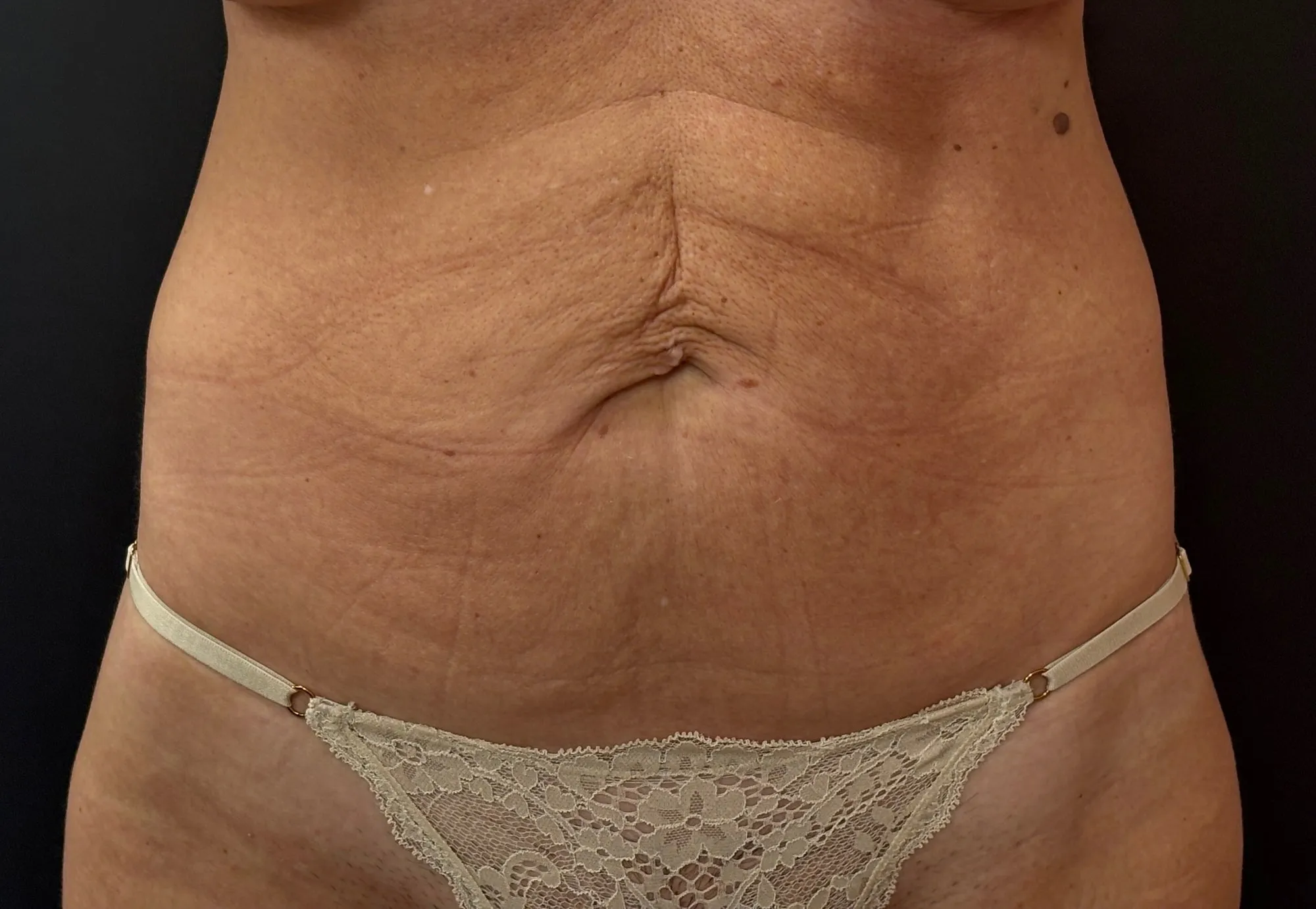 Tummy Tuck and Liposuction before — Tummy Tuck, view 1