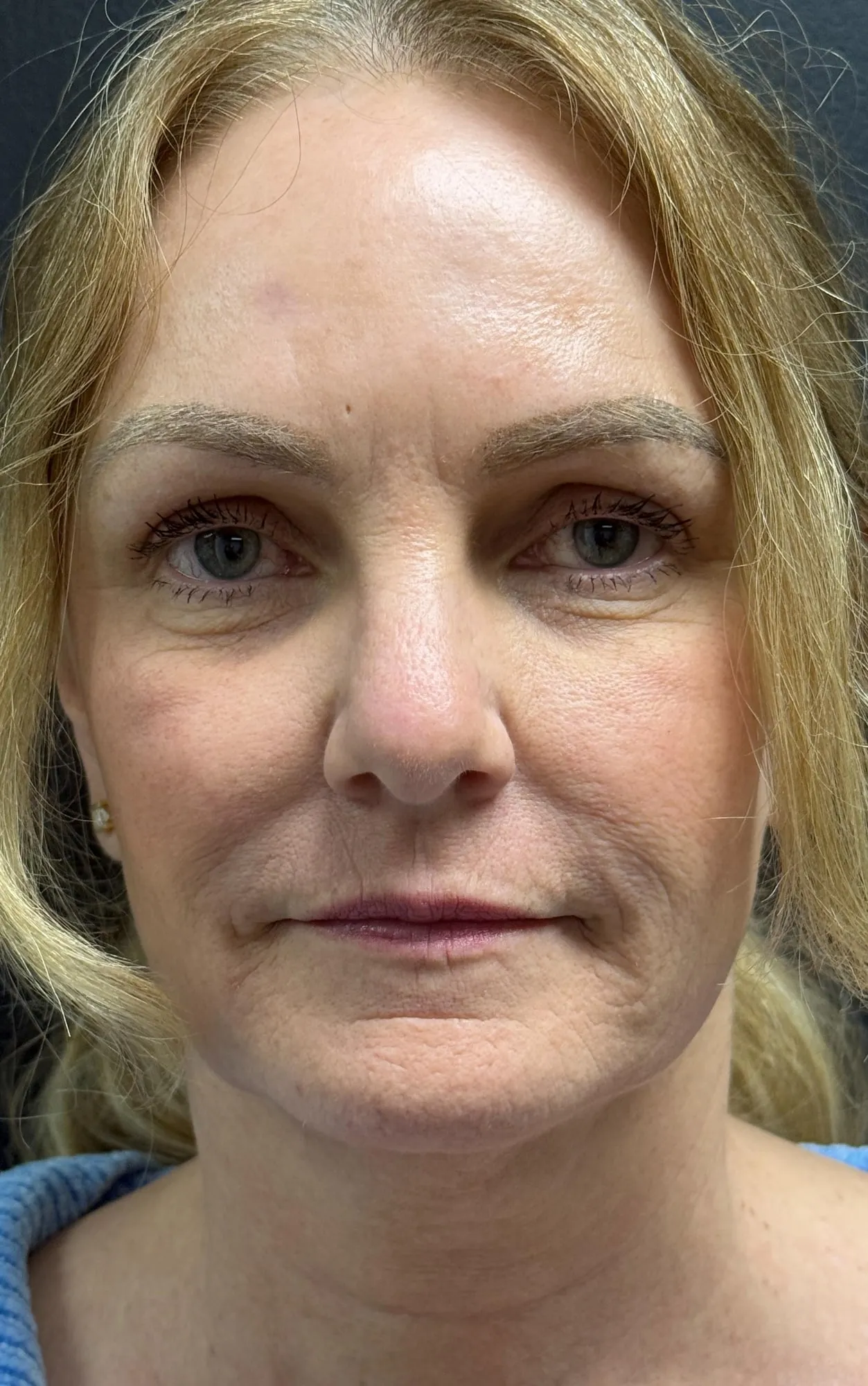 BBL Photorejuvenation after — BBL + HALO™ (1 treatment)