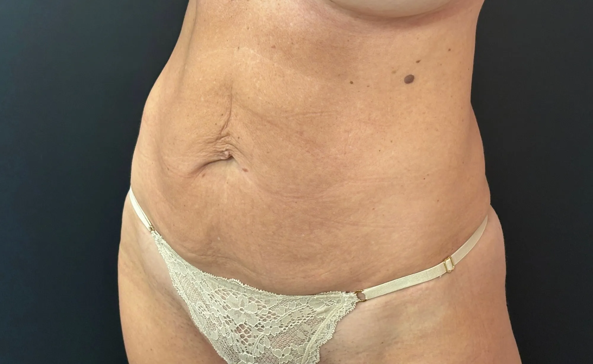 Tummy Tuck and Liposuction before — Tummy Tuck, view 2