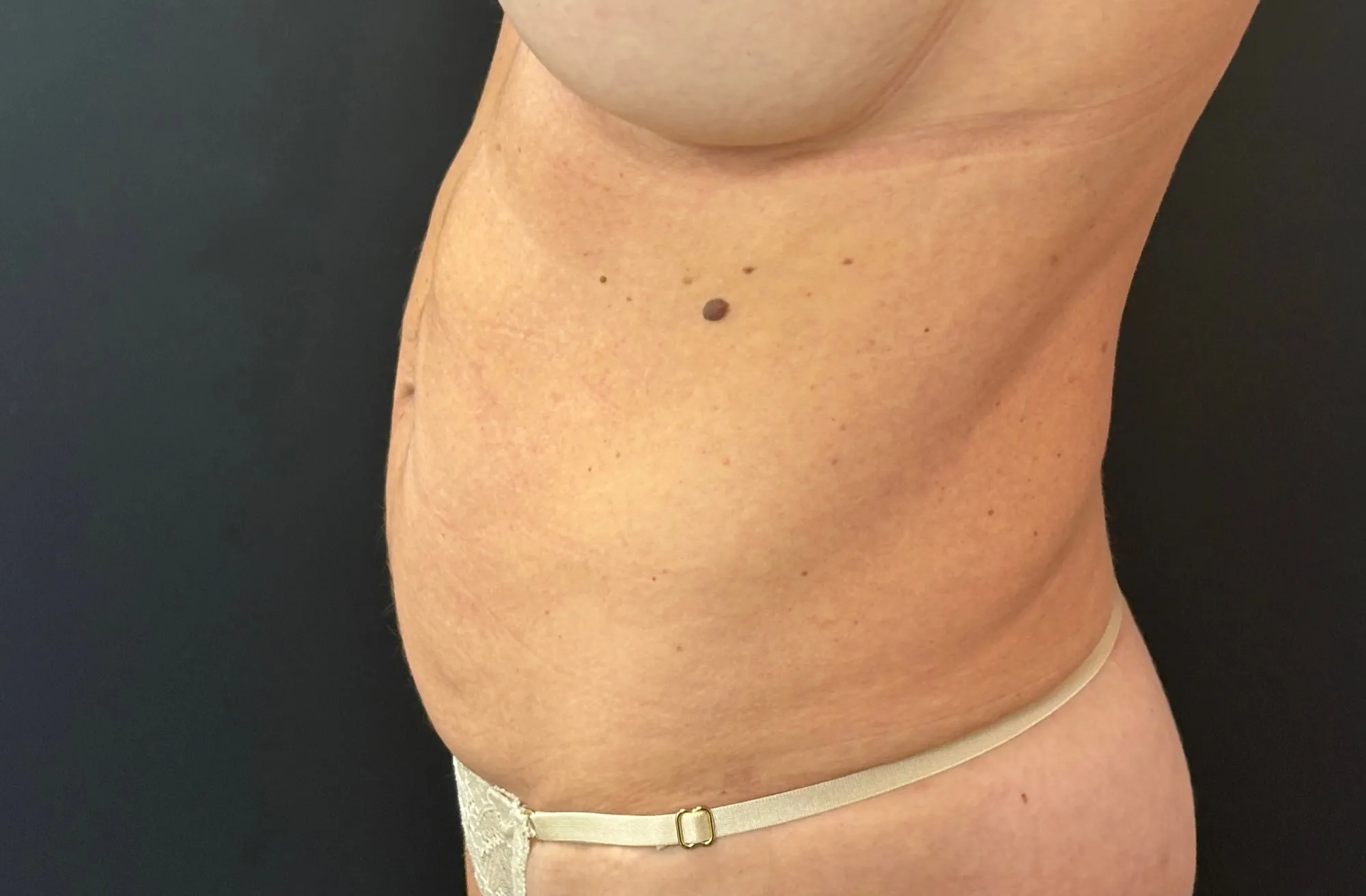 Tummy Tuck and Liposuction before — Tummy Tuck, view 3