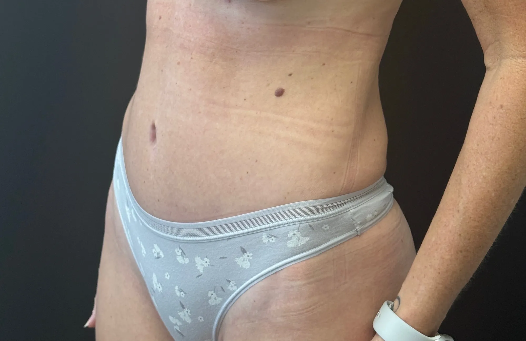 Tummy Tuck and Liposuction after — Tummy Tuck, view 2