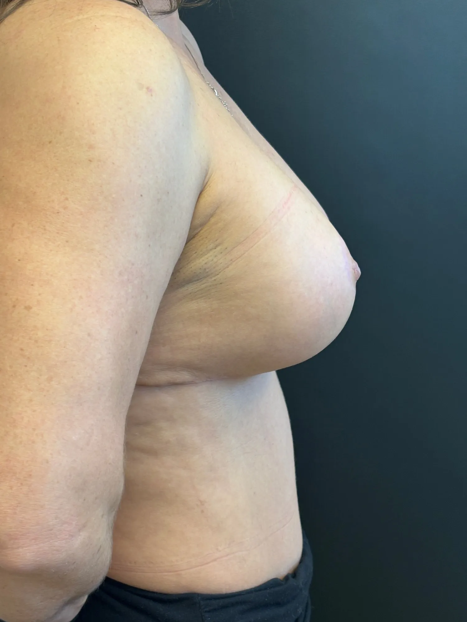Breast Implant Revision after — Breast Implant Downsize with Revision Breast Lift, view 3