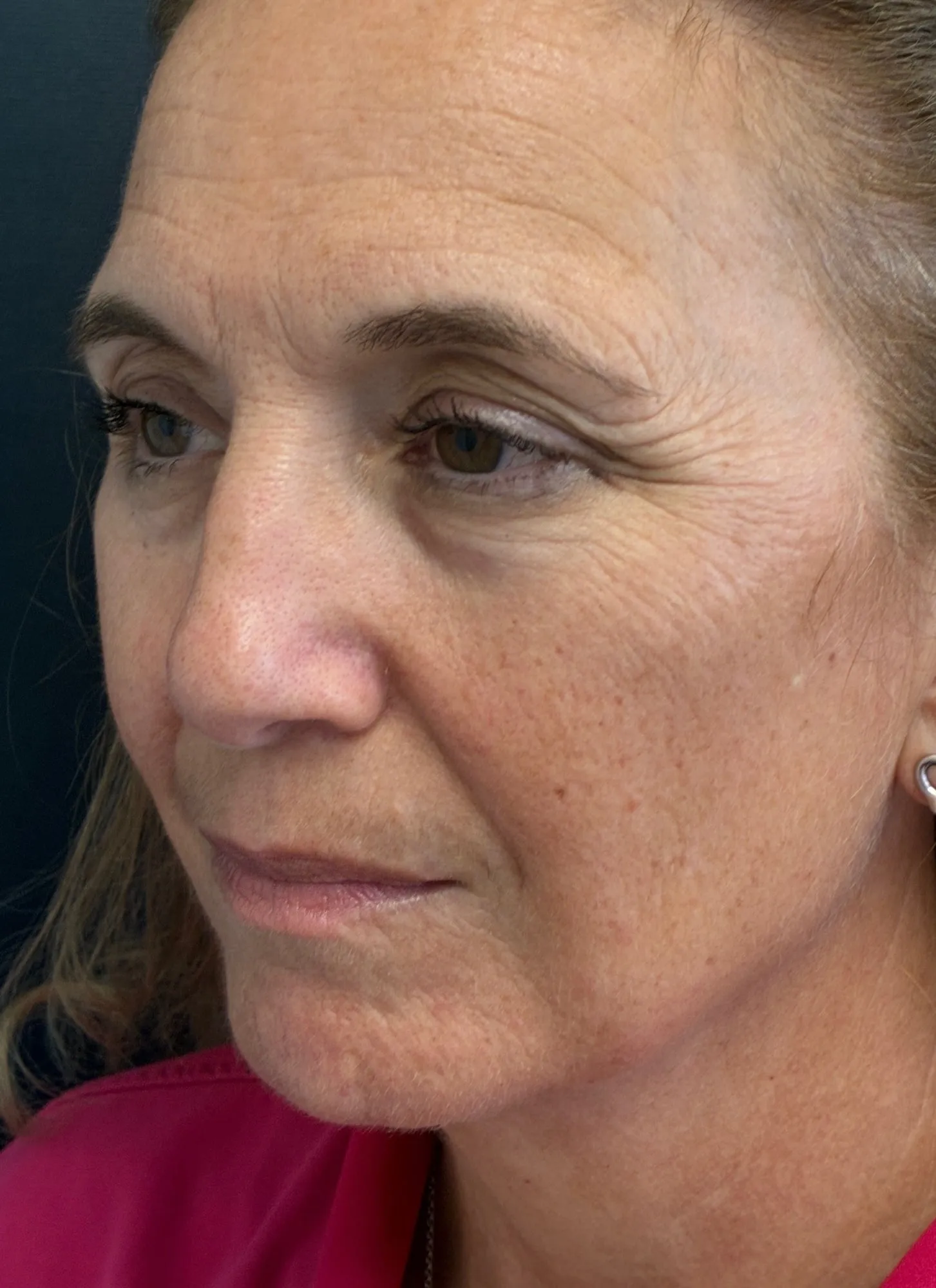 Brow lift patient, view 2, before surgery