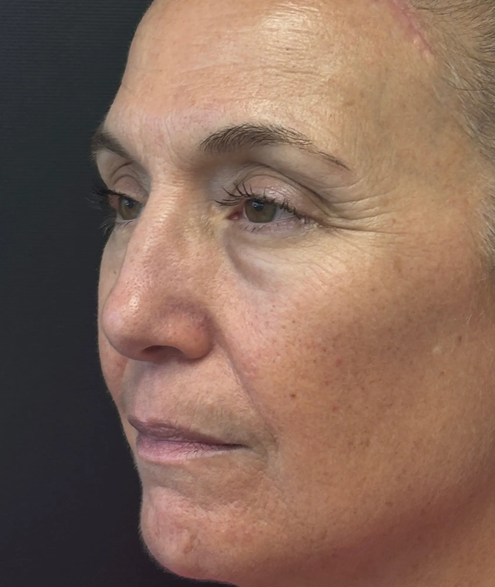 Brow lift patient, view 2, after surgery