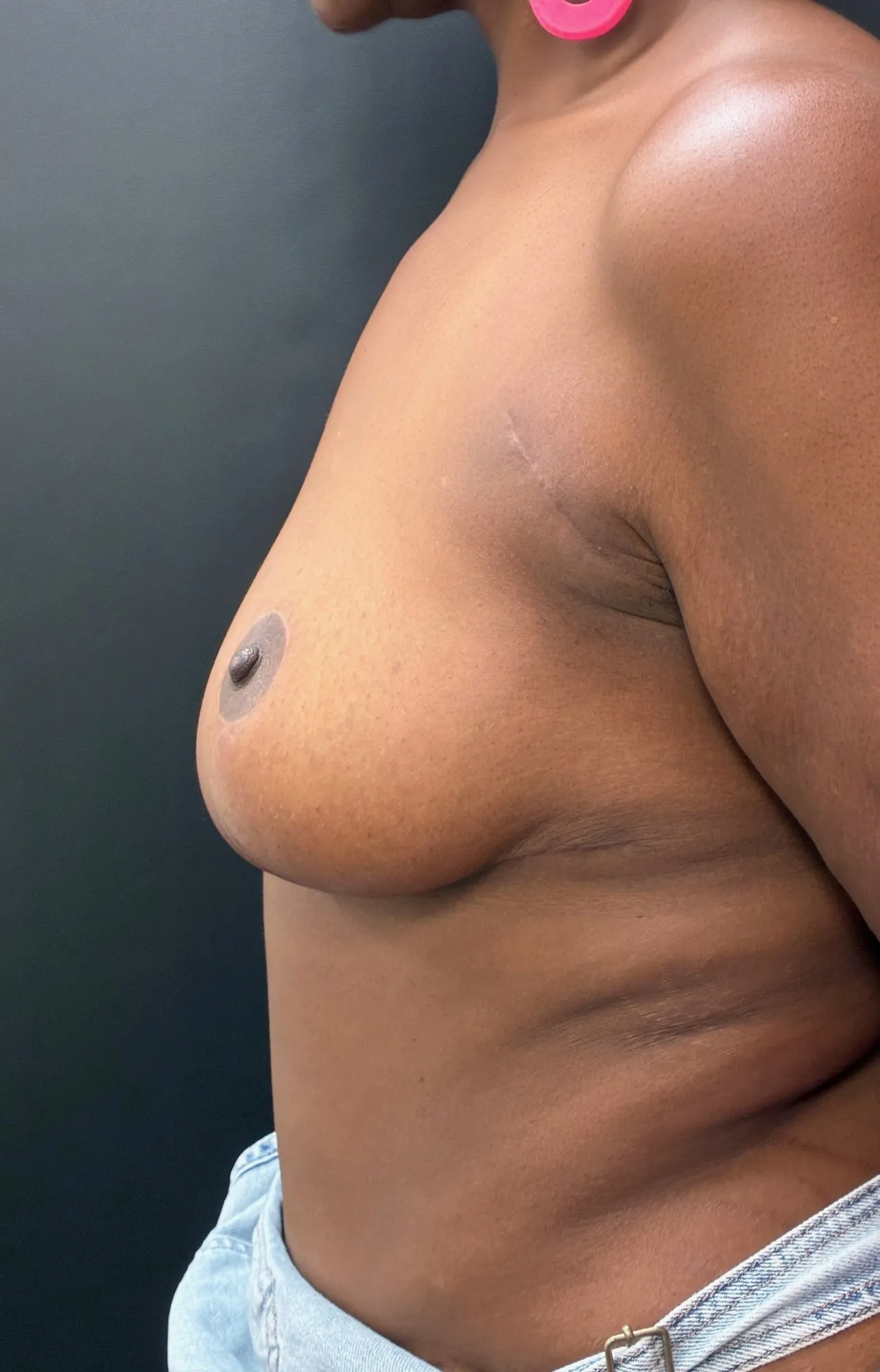 Breast Reduction after — Breast Reduction & Axillary Breast Tissue Removal, view 3