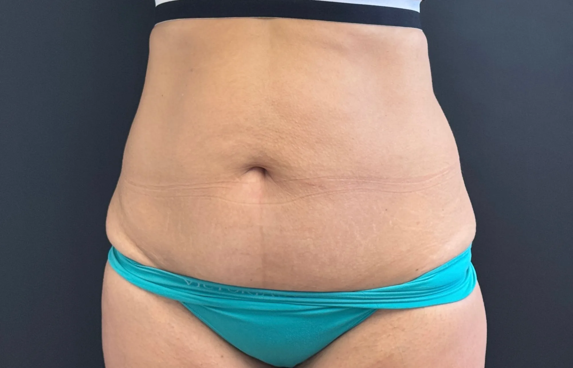 Tummy Tuck and Liposuction before — Tummy Tuck, view 1