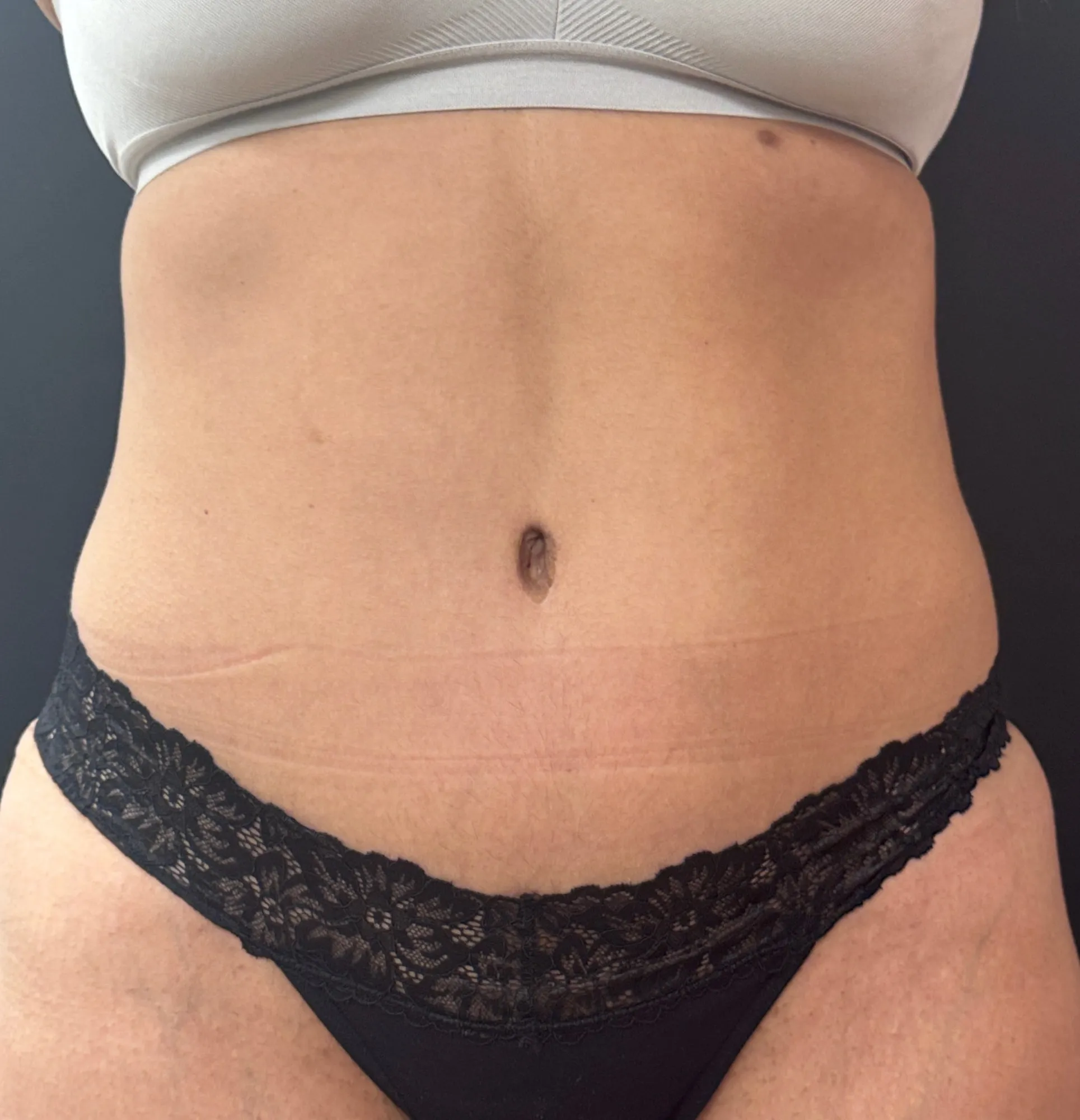 Tummy Tuck and Liposuction after — Tummy Tuck, view 1