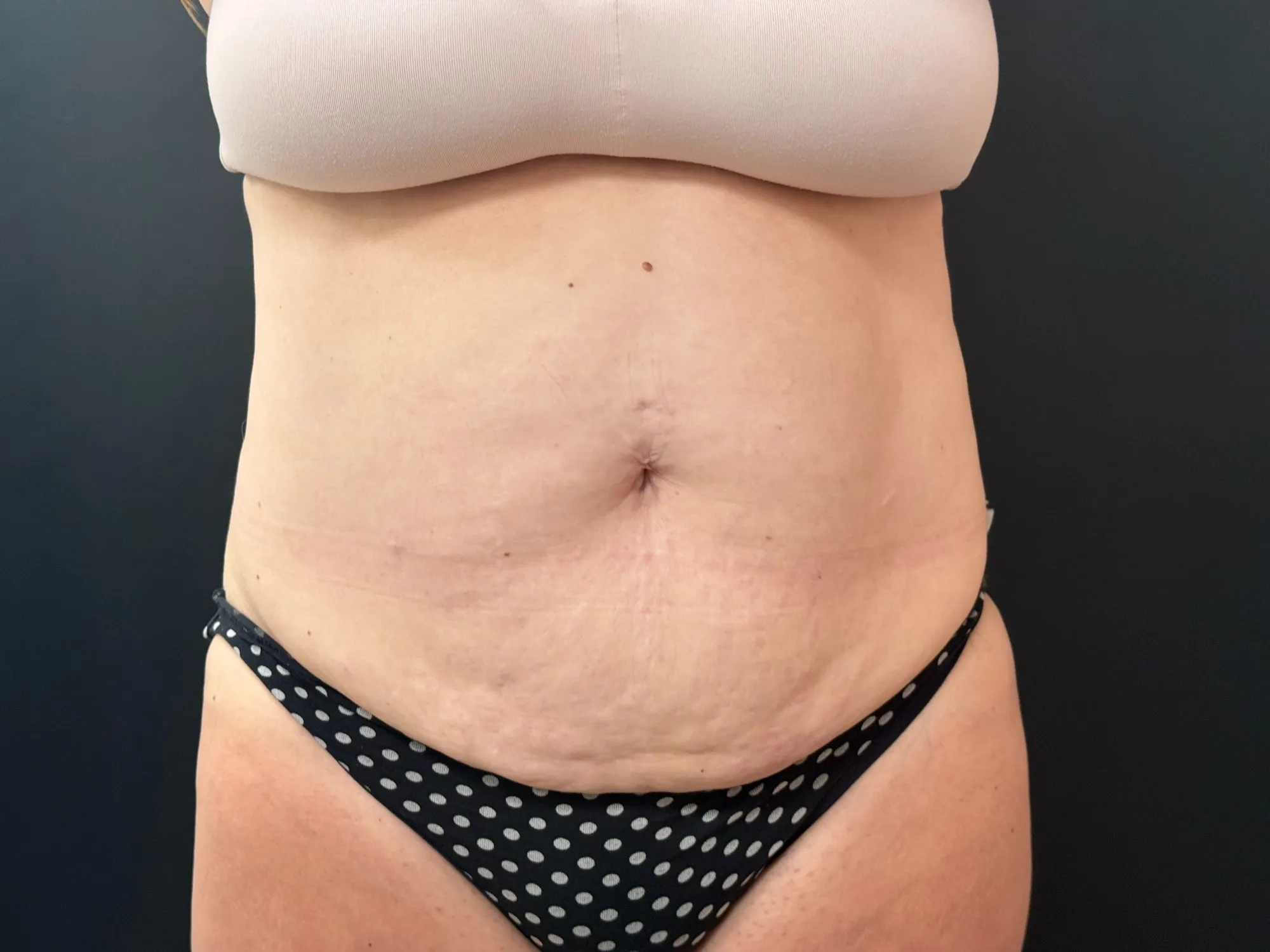 Tummy Tuck and Liposuction before — 360 Liposuction and Tummy Tuck, view 1