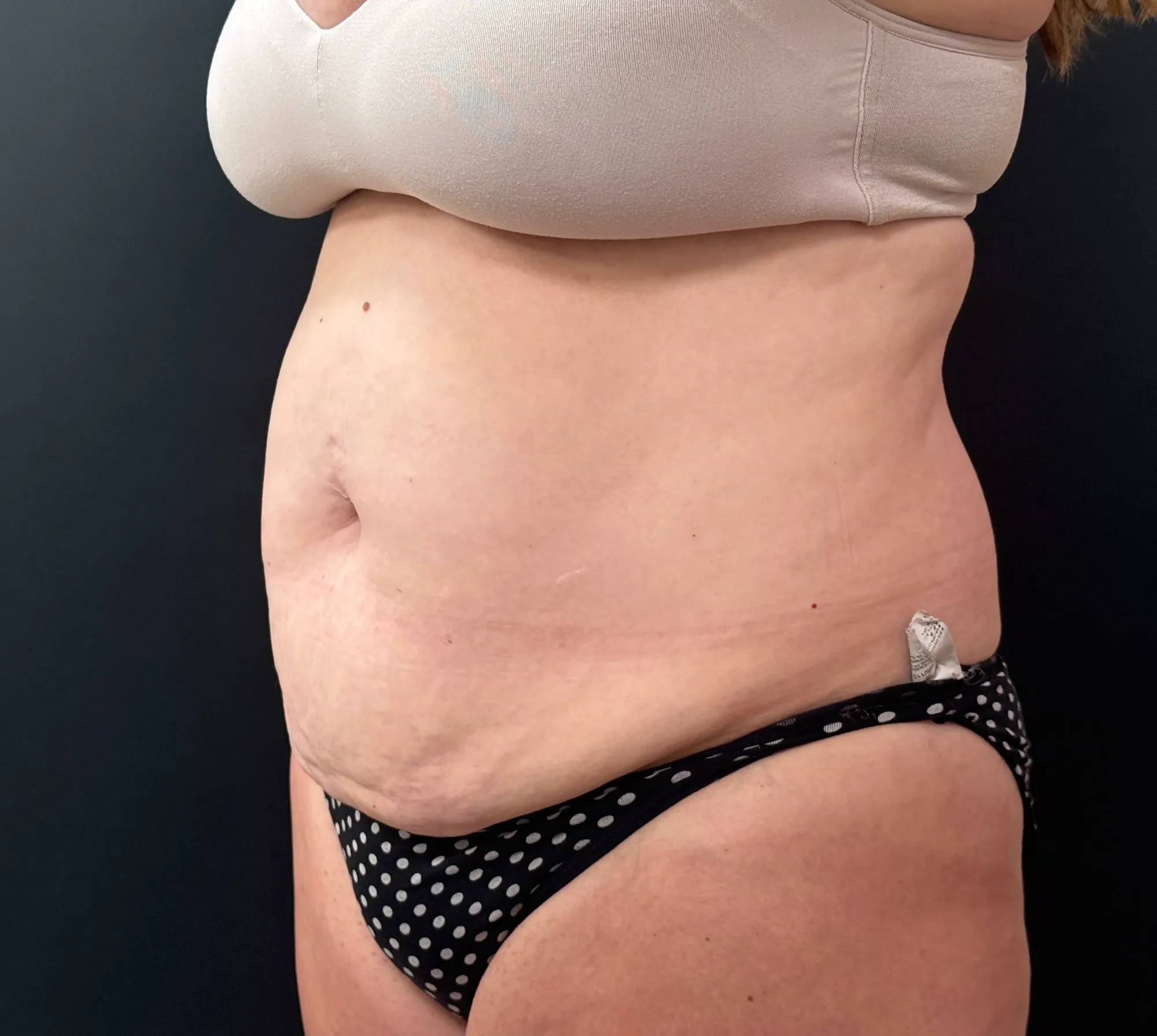 Tummy Tuck and Liposuction before — 360 Liposuction and Tummy Tuck, view 2