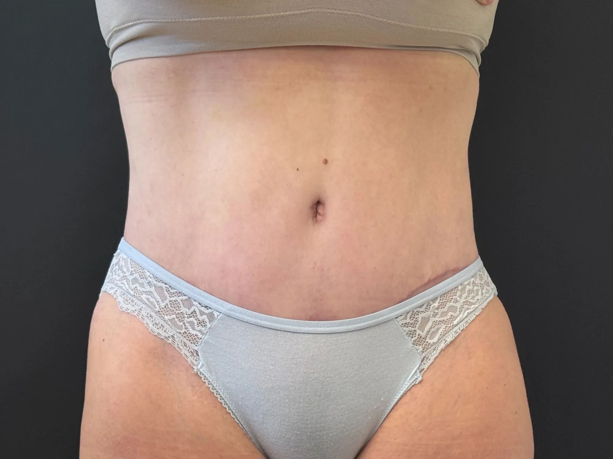 Tummy Tuck and Liposuction after — 360 Liposuction and Tummy Tuck, view 1