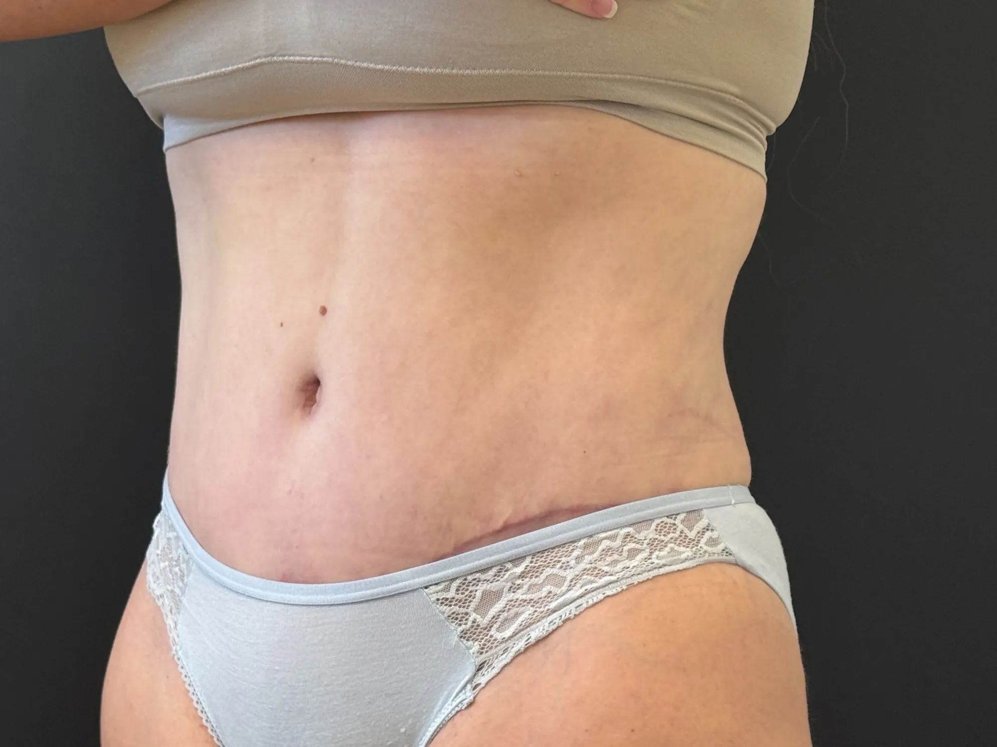 Tummy Tuck and Liposuction after — 360 Liposuction and Tummy Tuck, view 2