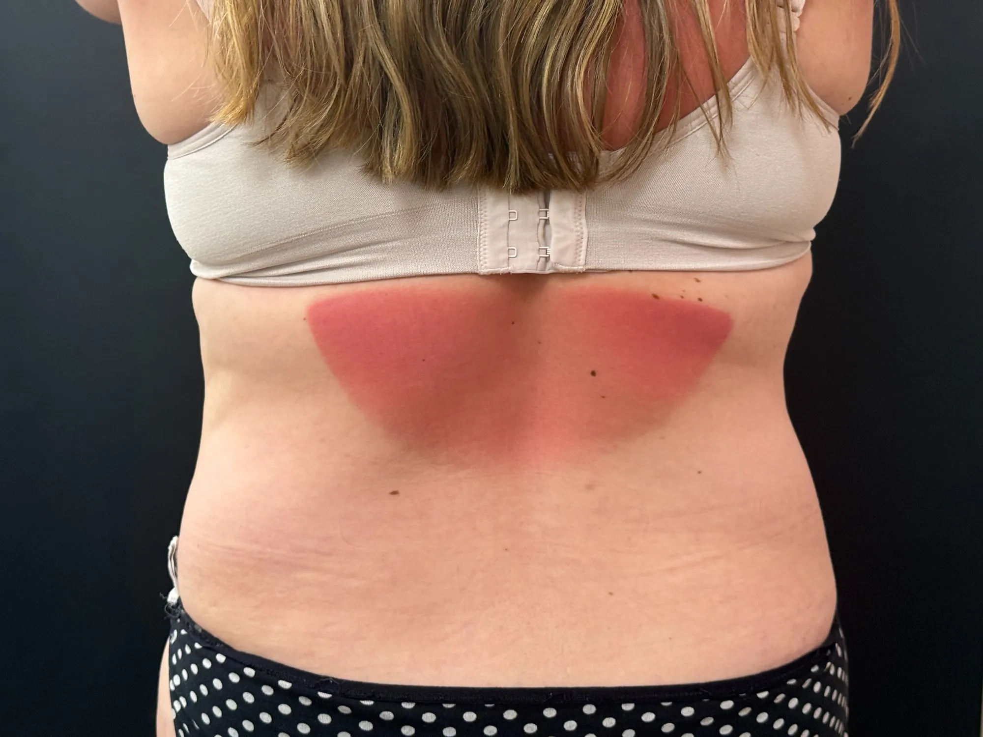 Tummy Tuck and Liposuction before — 360 Liposuction and Tummy Tuck, view 4