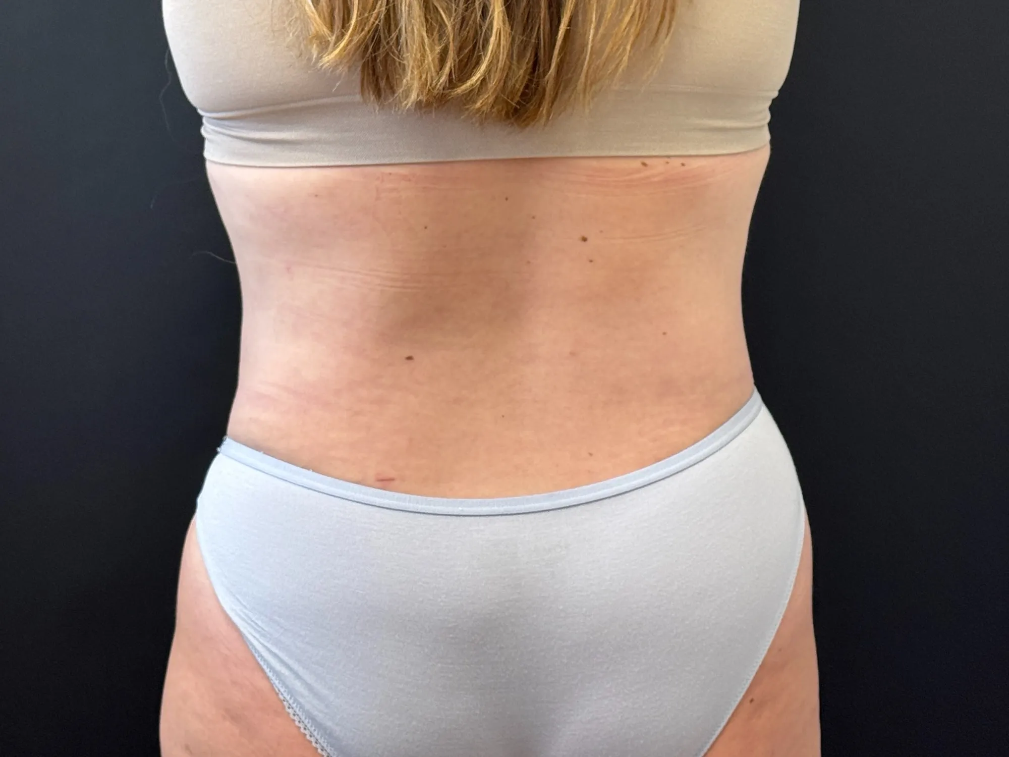 Tummy Tuck and Liposuction after — 360 Liposuction and Tummy Tuck, view 4
