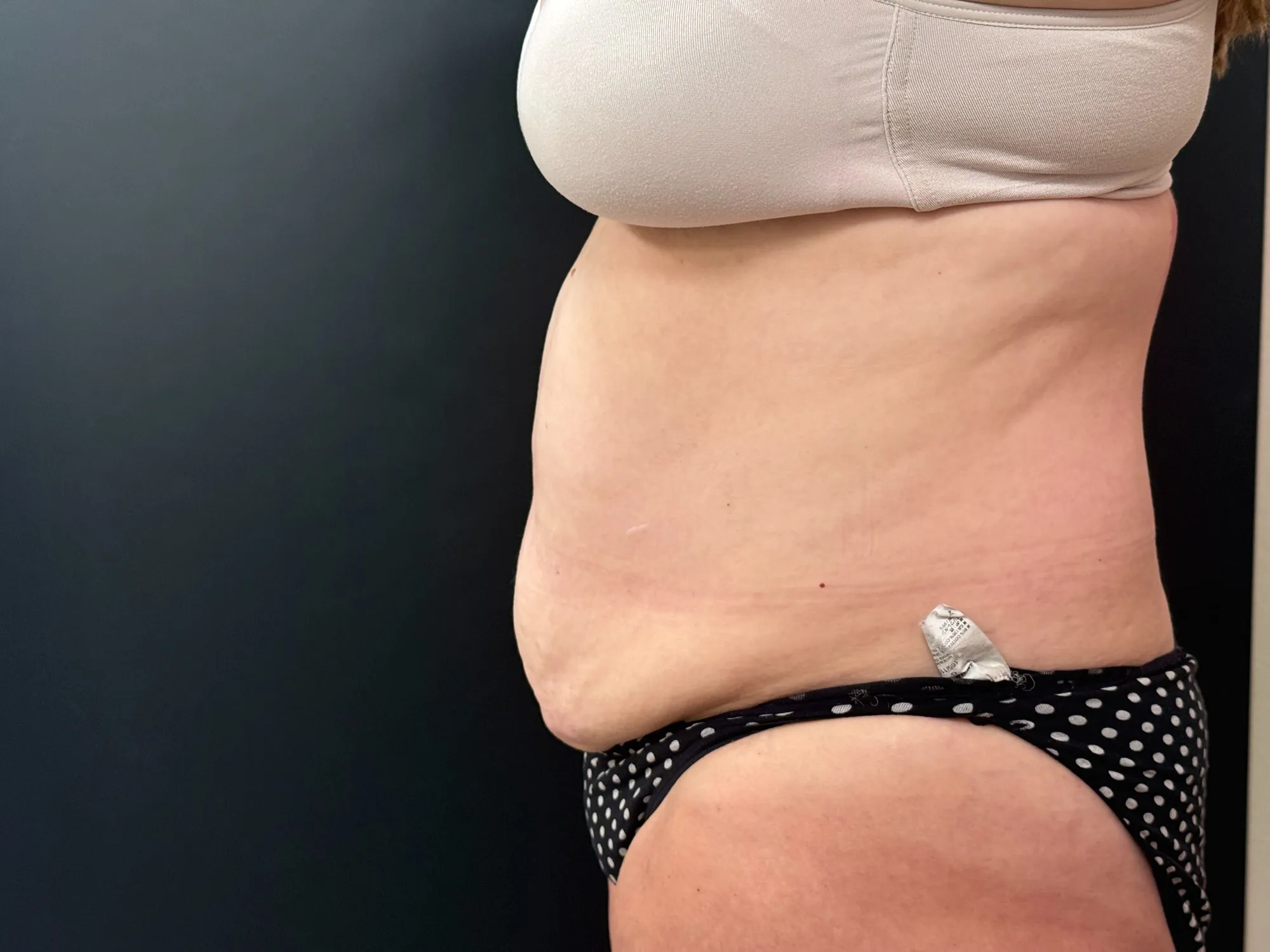 Tummy Tuck and Liposuction before — 360 Liposuction and Tummy Tuck, view 3