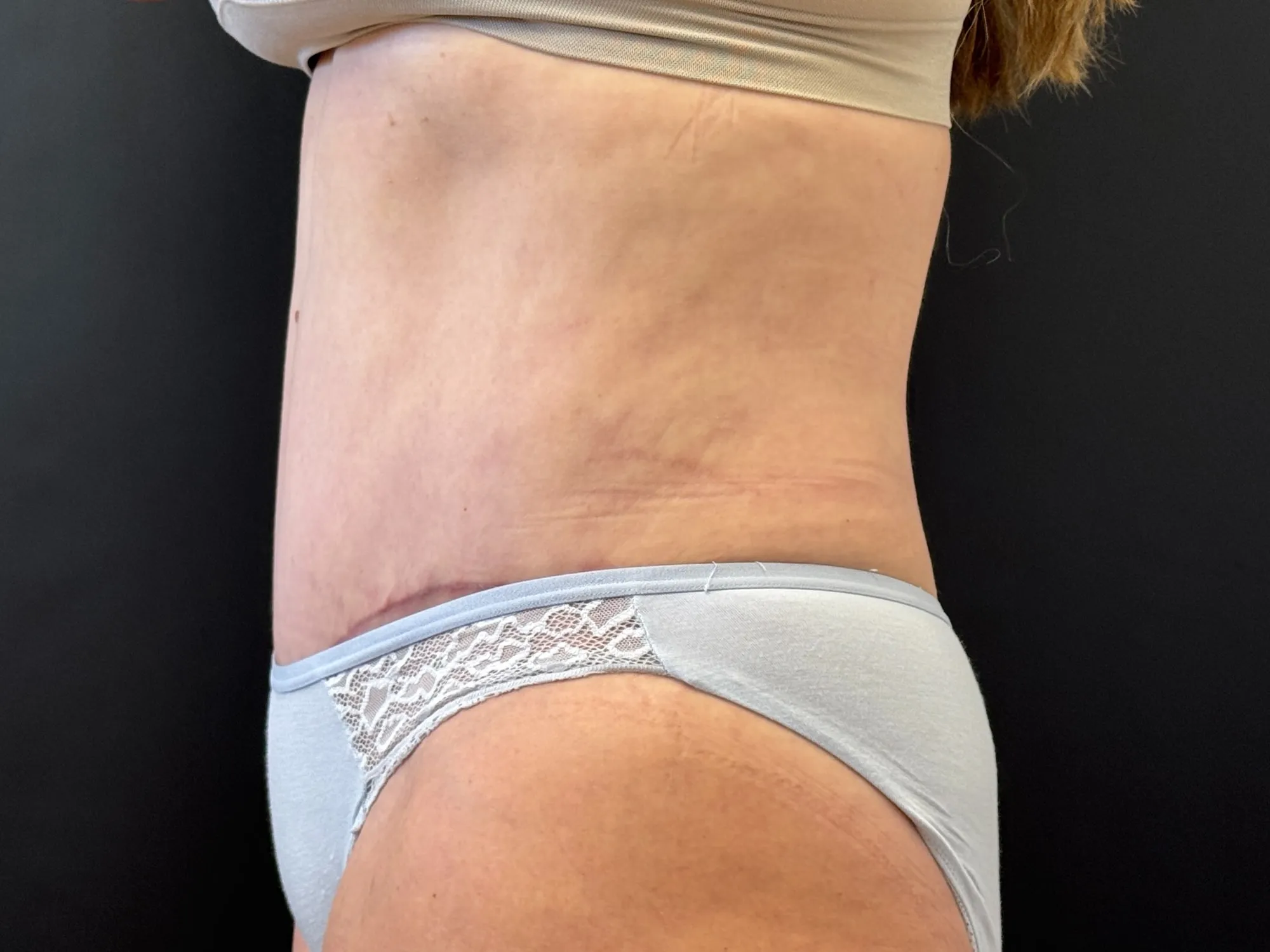 Tummy Tuck and Liposuction after — 360 Liposuction and Tummy Tuck, view 3